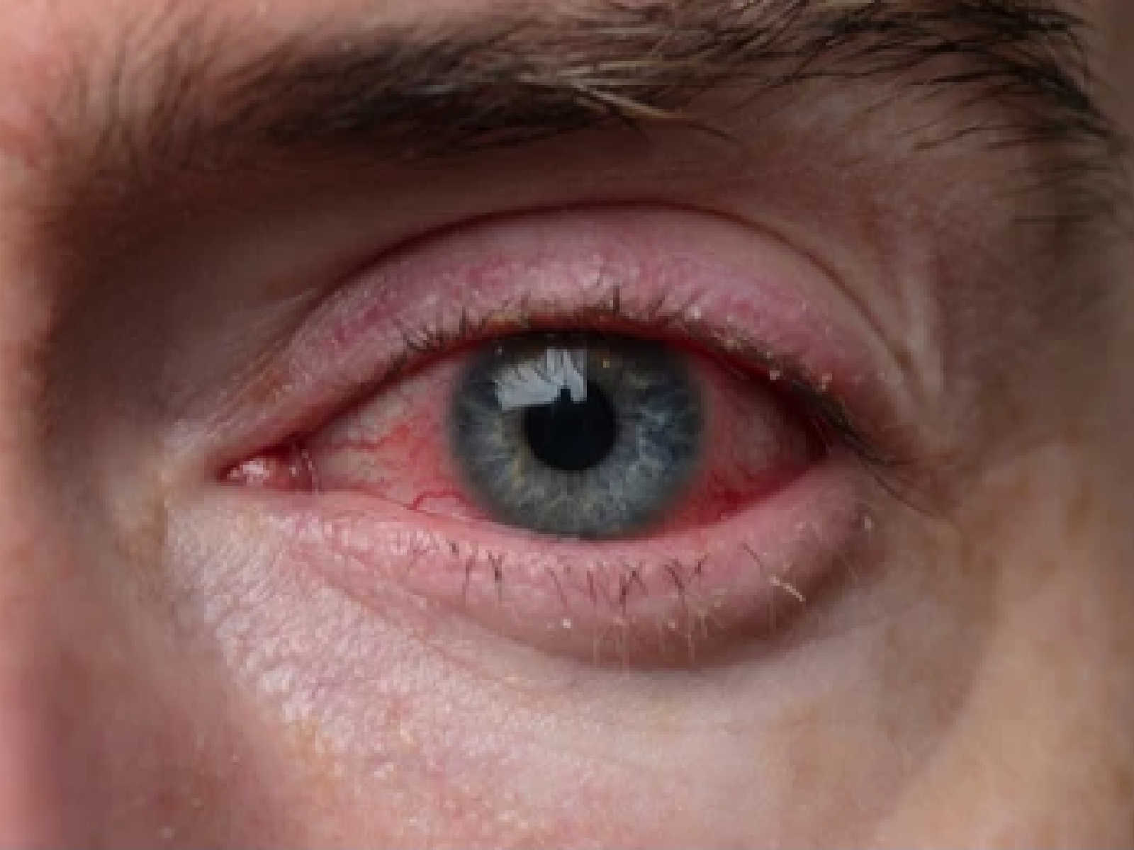 Close-up photo of a human eye with inflammation of the eyelids.