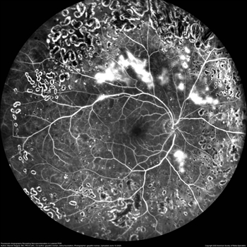 Fluorescein angiography image showing the branching pattern of retinal blood vessels